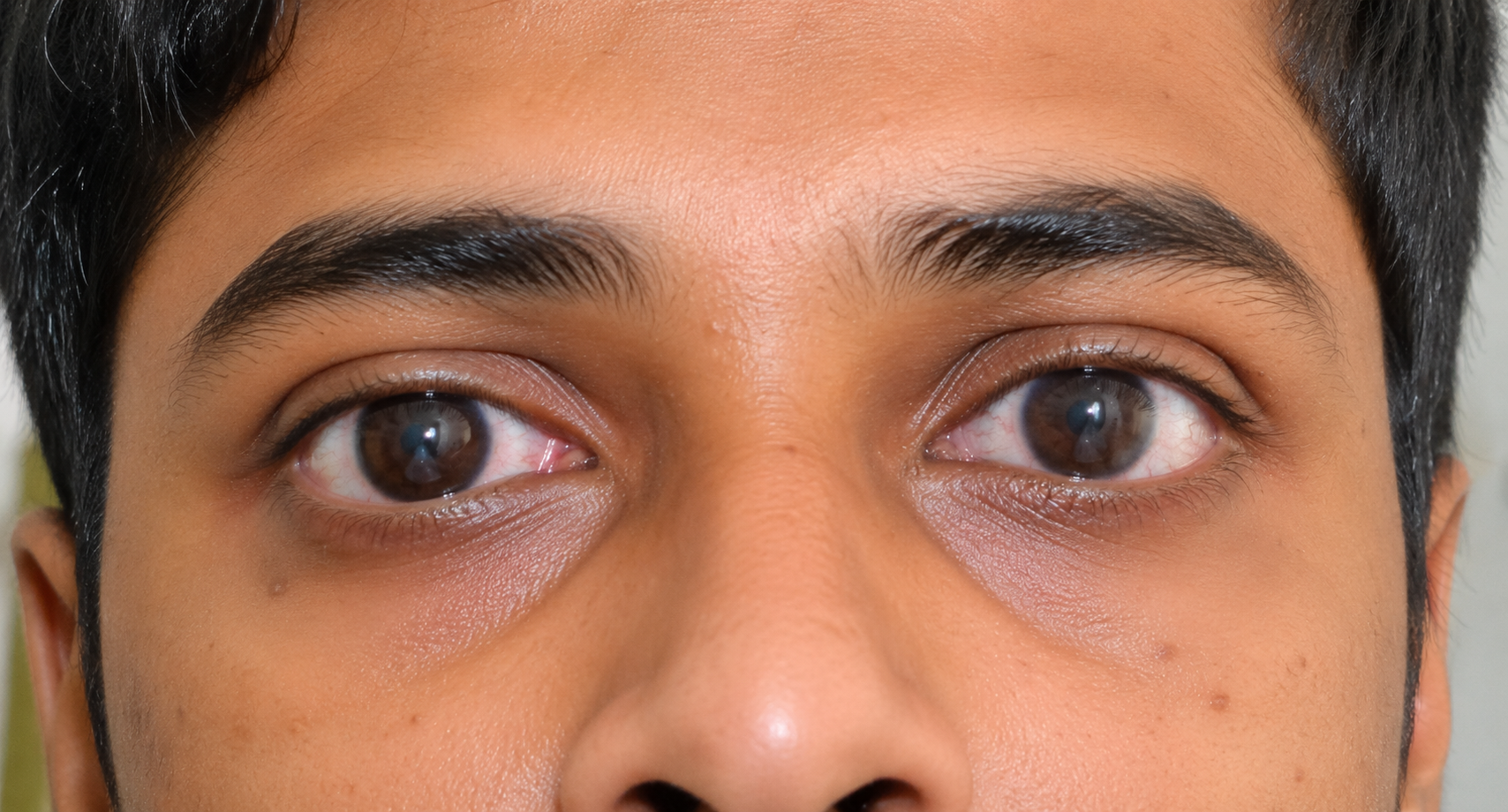 Glaucoma Clinic